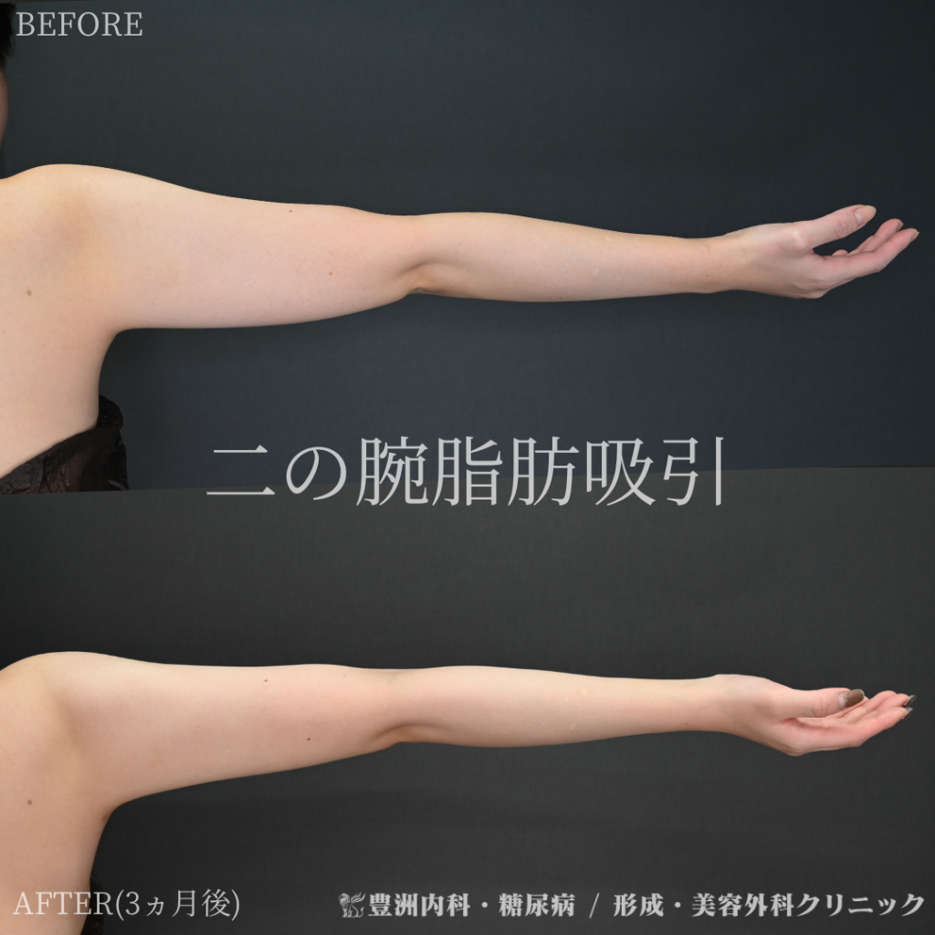 二の腕脂肪吸引 / 20代女性